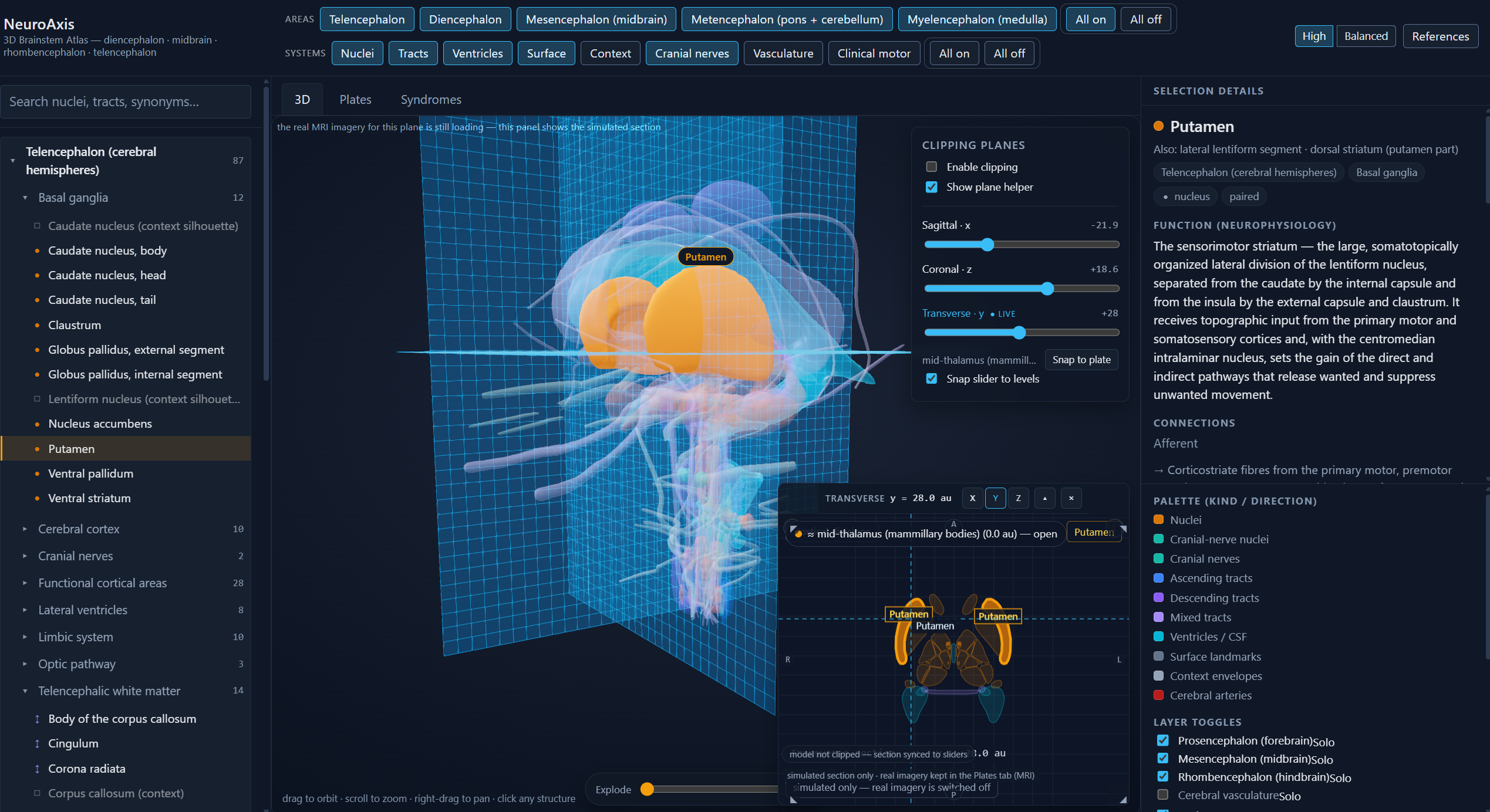 NeuroAxis 3D brain atlas with selected putamen and synchronized section